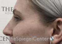Non-Surgical Rhinoplasty / Nose Filler Before & After Gallery - Patient 100390 - Image 4