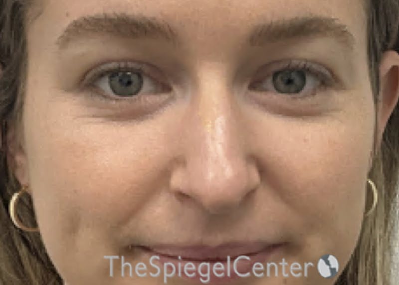 Non-Surgical Rhinoplasty / Nose Filler Before & After Gallery - Patient 126091 - Image 1
