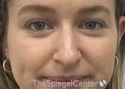 Non-Surgical Rhinoplasty / Nose Filler Before & After Gallery - Patient 126091 - Image 1