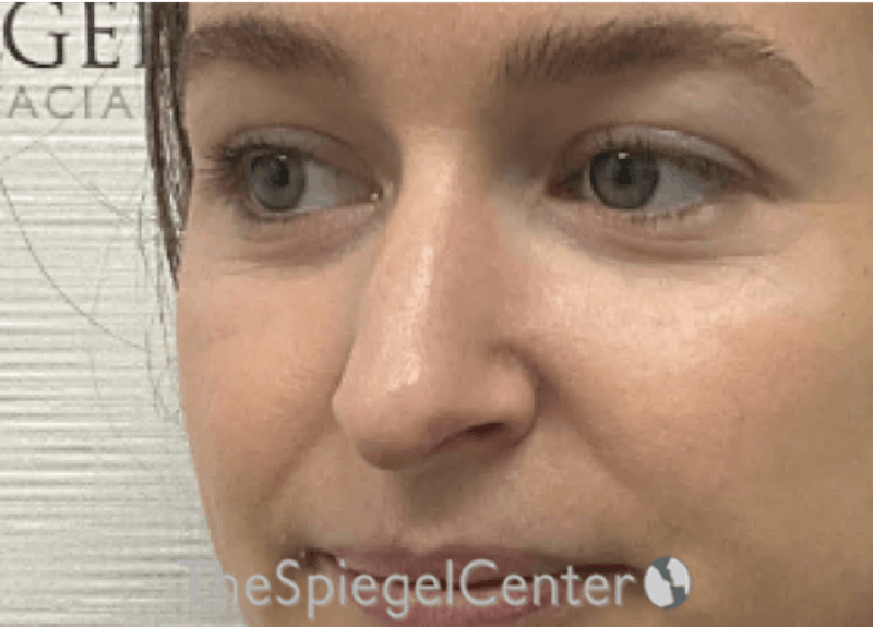 Non-Surgical Rhinoplasty / Nose Filler Before & After Gallery - Patient 126091 - Image 3
