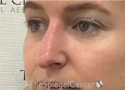 Non-Surgical Rhinoplasty / Nose Filler Before & After Gallery - Patient 126091 - Image 4