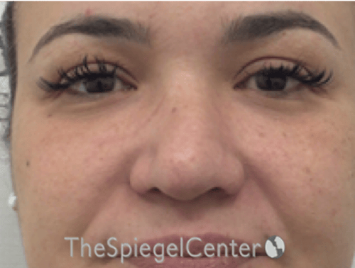 Non-Surgical Rhinoplasty / Nose Filler Before & After Gallery - Patient 114724 - Image 1