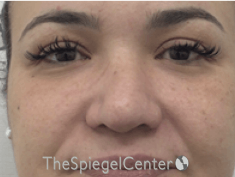 Non-Surgical Rhinoplasty / Nose Filler Before & After Gallery - Patient 114724 - Image 1