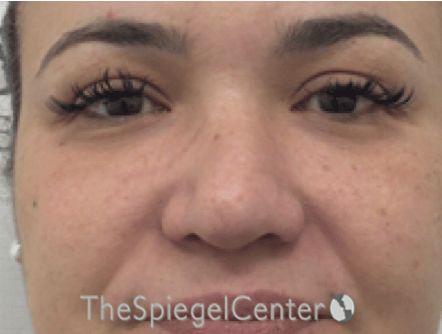 Non-Surgical Rhinoplasty / Nose Filler Before & After Gallery - Patient 114724 - Image 1