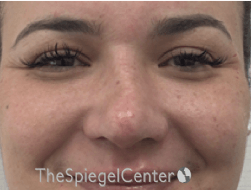 Non-Surgical Rhinoplasty / Nose Filler Before & After Gallery - Patient 114724 - Image 2