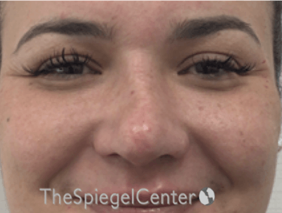 Non-Surgical Rhinoplasty / Nose Filler Before & After Gallery - Patient 114724 - Image 2