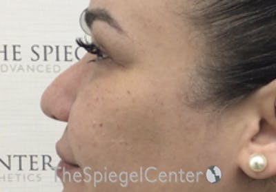 Non-Surgical Rhinoplasty / Nose Filler Before & After Gallery - Patient 114724 - Image 3