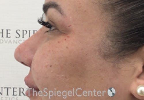 Non-Surgical Rhinoplasty / Nose Filler Before & After Gallery - Patient 114724 - Image 4