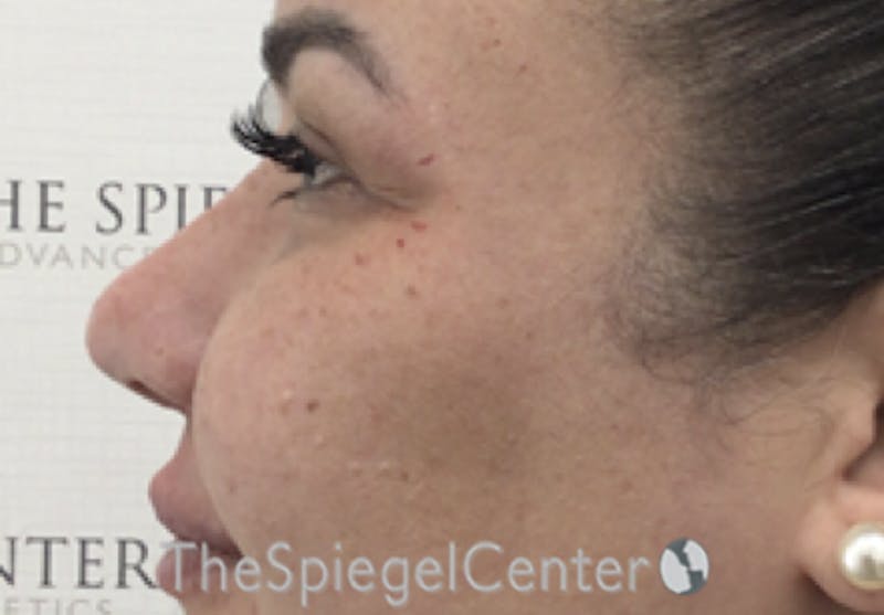 Non-Surgical Rhinoplasty / Nose Filler Before & After Gallery - Patient 114724 - Image 4