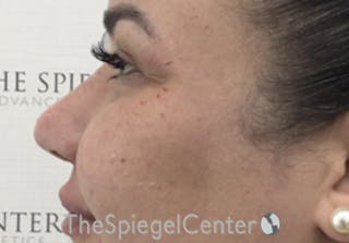 Non-Surgical Rhinoplasty / Nose Filler Before & After Gallery - Patient 114724 - Image 4