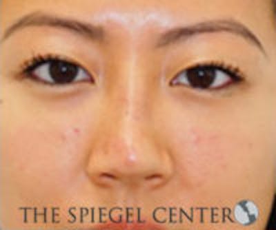 Non-Surgical Rhinoplasty / Nose Filler Before & After Gallery - Patient 298614 - Image 1