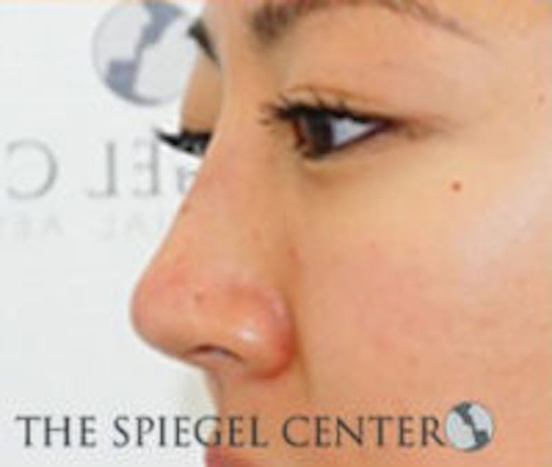 Non-Surgical Rhinoplasty / Nose Filler Before & After Gallery - Patient 298614 - Image 3
