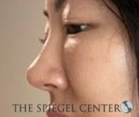Non-Surgical Rhinoplasty Before & After Gallery - Patient 161206 - Image 4