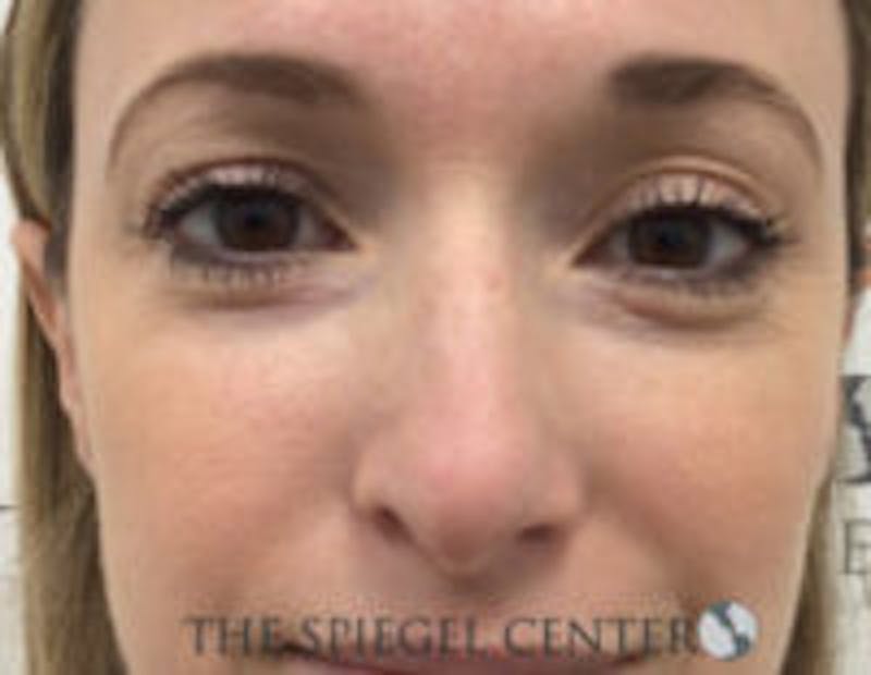 Non-Surgical Rhinoplasty / Nose Filler Before & After Gallery - Patient 518838 - Image 1