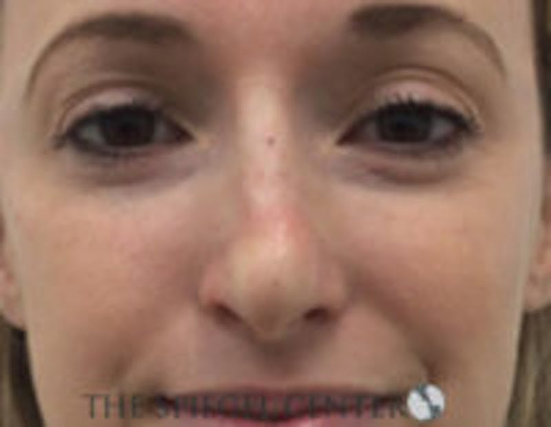 Non-Surgical Rhinoplasty / Nose Filler Before & After Gallery - Patient 518838 - Image 2