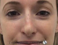 Non-Surgical Rhinoplasty / Nose Filler Before & After Gallery - Patient 518838 - Image 2