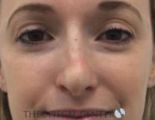 Non-Surgical Rhinoplasty / Nose Filler Before & After Gallery - Patient 518838 - Image 2