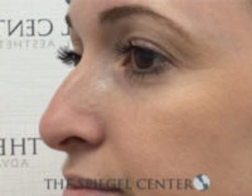 Non-Surgical Rhinoplasty / Nose Filler Before & After Gallery - Patient 518838 - Image 3