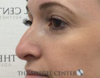 Non-Surgical Rhinoplasty / Nose Filler Before & After Gallery - Patient 518838 - Image 3