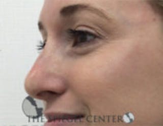 Non-Surgical Rhinoplasty / Nose Filler Before & After Gallery - Patient 518838 - Image 4