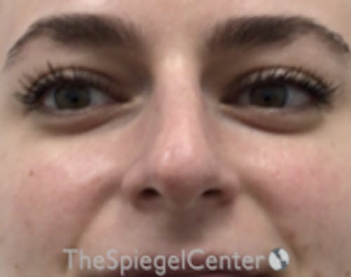 Non-Surgical Rhinoplasty / Nose Filler Before & After Gallery - Patient 759498 - Image 1