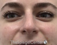 Non-Surgical Rhinoplasty / Nose Filler Before & After Gallery - Patient 759498 - Image 1