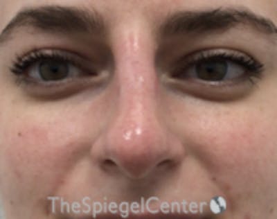 Non-Surgical Rhinoplasty / Nose Filler Before & After Gallery - Patient 759498 - Image 2