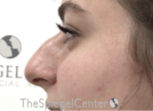 Non-Surgical Rhinoplasty / Nose Filler Before & After Gallery - Patient 759498 - Image 3