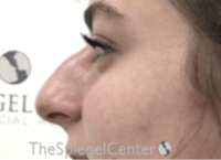 Non-Surgical Rhinoplasty / Nose Filler Before & After Gallery - Patient 759498 - Image 3