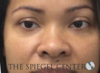 Non-Surgical Rhinoplasty / Nose Filler Before & After Gallery - Patient 139744 - Image 1