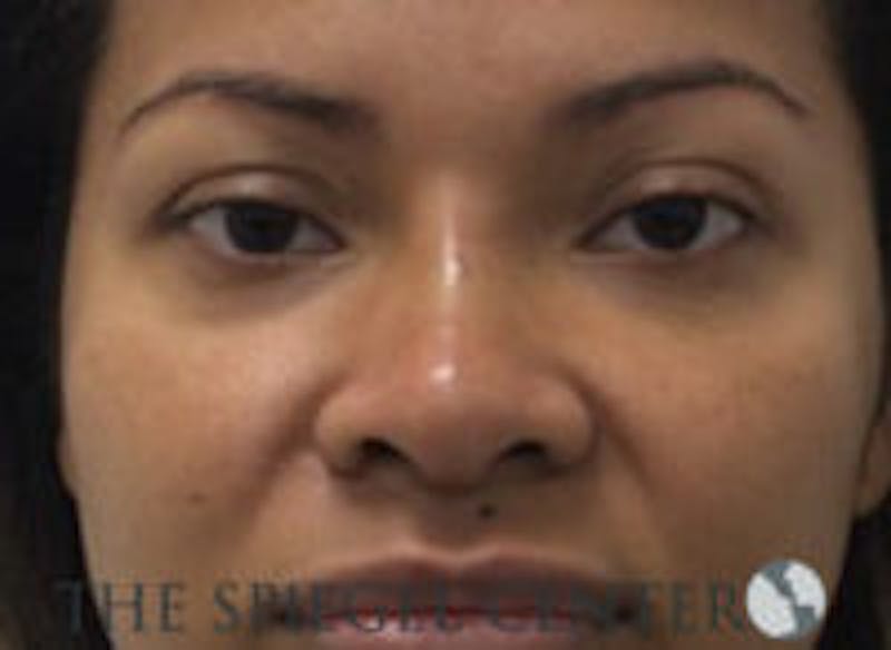 Non-Surgical Rhinoplasty / Nose Filler Before & After Gallery - Patient 139744 - Image 2