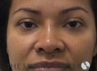 Non-Surgical Rhinoplasty / Nose Filler Before & After Gallery - Patient 139744 - Image 2
