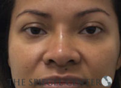 Non-Surgical Rhinoplasty / Nose Filler Before & After Gallery - Patient 139744 - Image 2