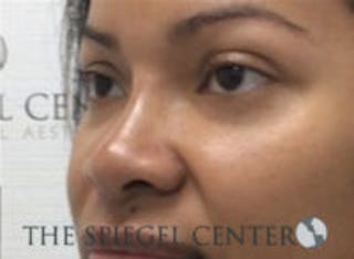 Non-Surgical Rhinoplasty / Nose Filler Before & After Gallery - Patient 139744 - Image 4