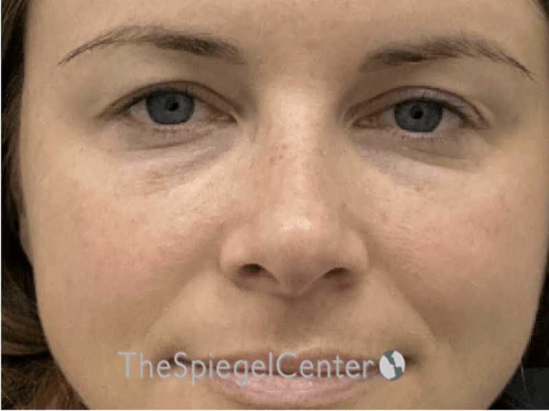 Non-Surgical Rhinoplasty / Nose Filler Before & After Gallery - Patient 390547 - Image 1