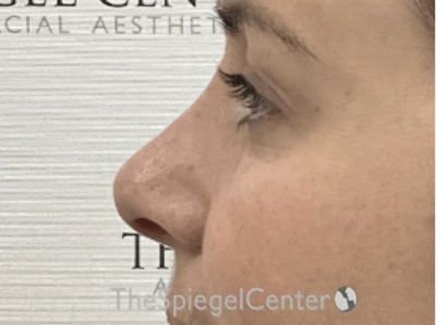 Non-Surgical Rhinoplasty / Nose Filler Before & After Gallery - Patient 390547 - Image 4