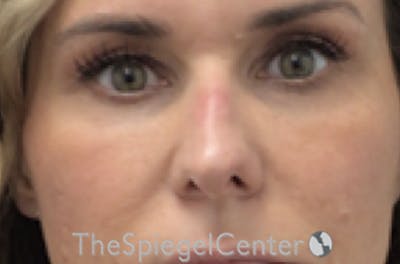 Non-Surgical Rhinoplasty / Nose Filler Before & After Gallery - Patient 723651 - Image 1
