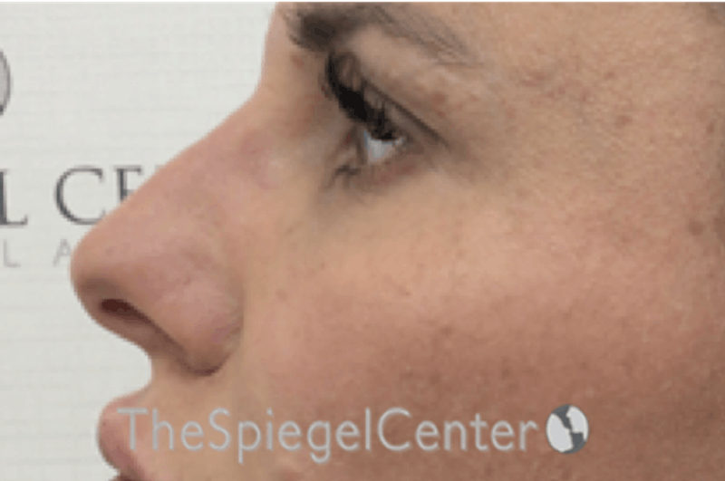 Non-Surgical Rhinoplasty / Nose Filler Before & After Gallery - Patient 723651 - Image 4