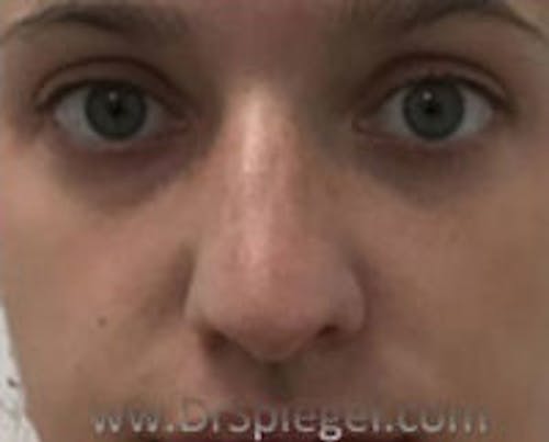 Non-Surgical Rhinoplasty / Nose Filler Before & After Gallery - Patient 396160 - Image 1