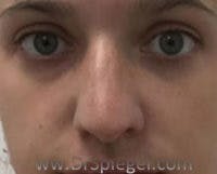 Non-Surgical Rhinoplasty / Nose Filler Before & After Gallery - Patient 396160 - Image 1