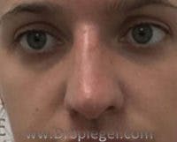 Non-Surgical Rhinoplasty / Nose Filler Before & After Gallery - Patient 396160 - Image 2