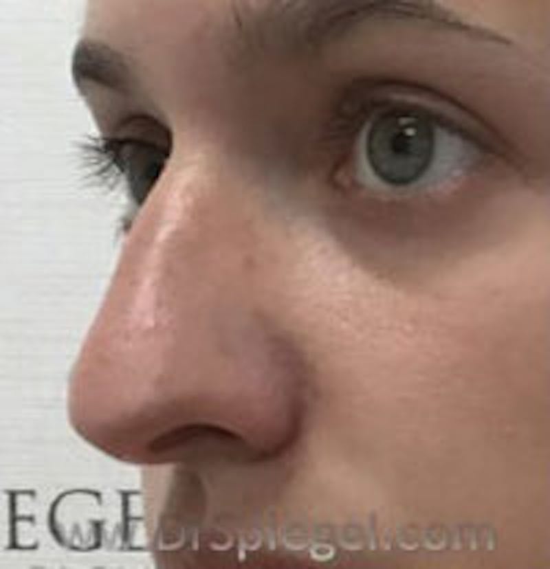 Non-Surgical Rhinoplasty / Nose Filler Before & After Gallery - Patient 396160 - Image 3