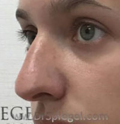 Non-Surgical Rhinoplasty / Nose Filler Before & After Gallery - Patient 396160 - Image 3