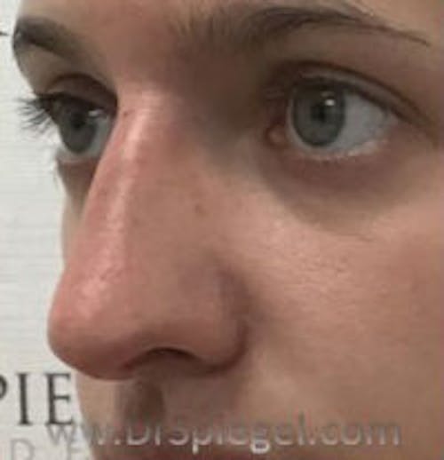 Non-Surgical Rhinoplasty / Nose Filler Before & After Gallery - Patient 396160 - Image 4