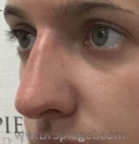 Non-Surgical Rhinoplasty / Nose Filler Before & After Gallery - Patient 396160 - Image 4