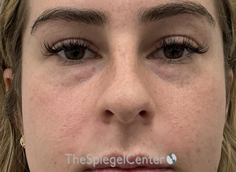 Non-Surgical Rhinoplasty / Nose Filler Before & After Gallery - Patient 242390 - Image 1