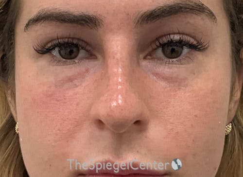 Non-Surgical Rhinoplasty / Nose Filler Before & After Gallery - Patient 242390 - Image 2