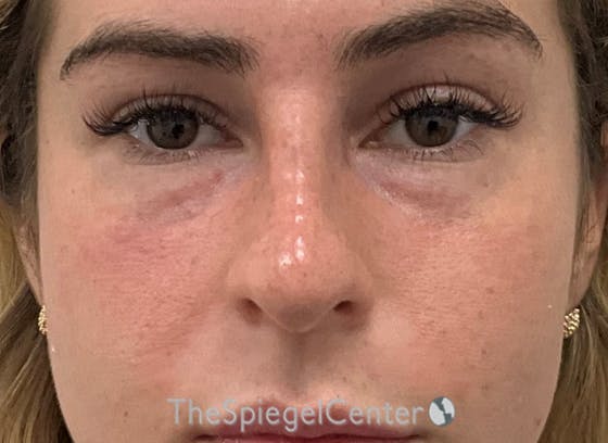 Non-Surgical Rhinoplasty / Nose Filler Before & After Gallery - Patient 242390 - Image 2