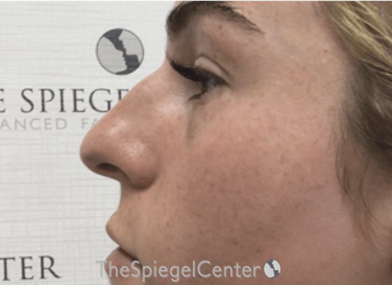 Non-Surgical Rhinoplasty / Nose Filler Before & After Gallery - Patient 242390 - Image 3