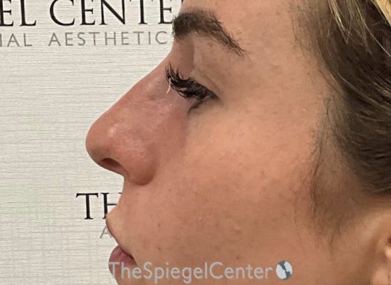 Non-Surgical Rhinoplasty / Nose Filler Before & After Gallery - Patient 242390 - Image 4